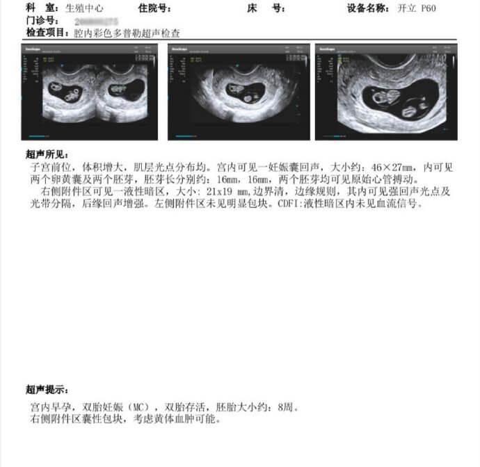 29岁试管成功案例