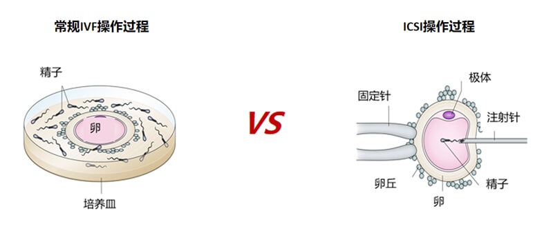 试管一代和二代的区别