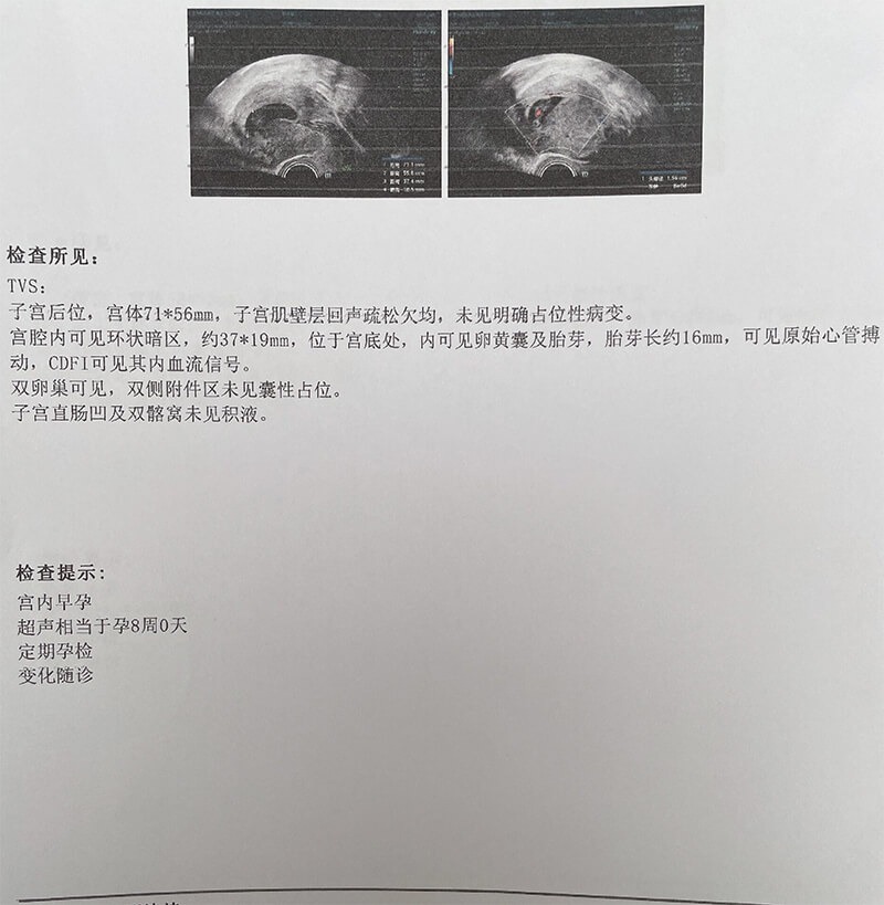 婚后多囊不孕试管移植双胎成功